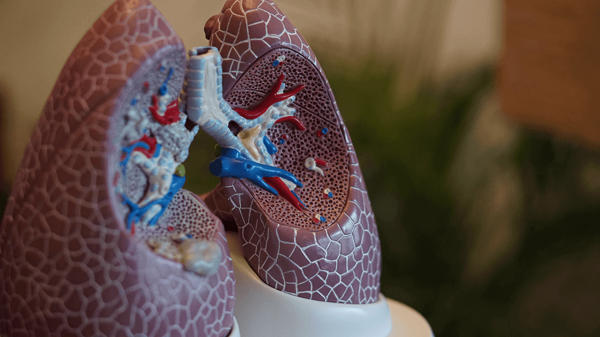 Countertop Silicosis Lawsuit
